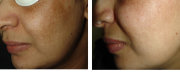 Активная обновляющая маска для кожи с пигментацией 50 мл M.E.L.A. 1 powerclay / pHformula