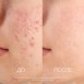 Лечебный акнэ лосьон 125 мл Eldan Cosmetics / Элдан